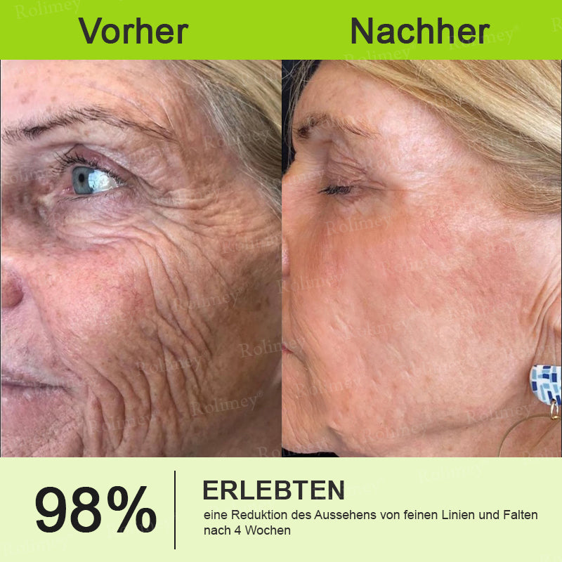 🛡️Jetzt jugendliche Haut zurückgewinnen Rolimey® Botox & Vita-A Retinol Shot Falten-Lift Straffungscreme