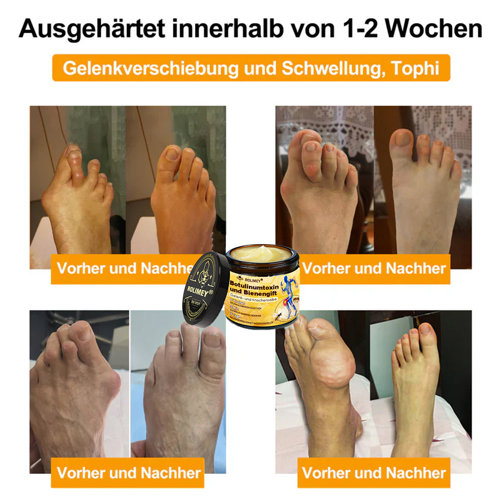 🥰 Offizieller Shop: Rolimey® Bienengift-Schmerzlinderungs Knochenheilungs Creme 👨‍⚕️(Reduzierung von Gelenkschwellungen, Schmerzen, Steifheit, Rötungen, Wärme, Muskelkater und Gelenkmüdigkeit)