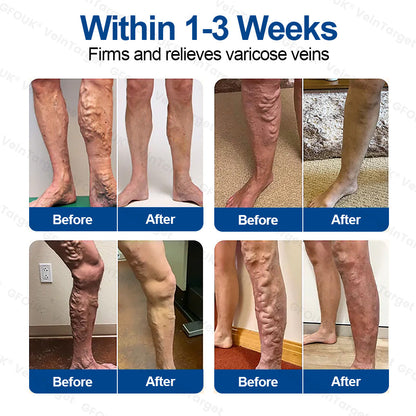 🇬🇧👨‍⚕️✅GFOUK® VeinTarget Microneedle Patch⚡Instant Relief, Long-Term Results