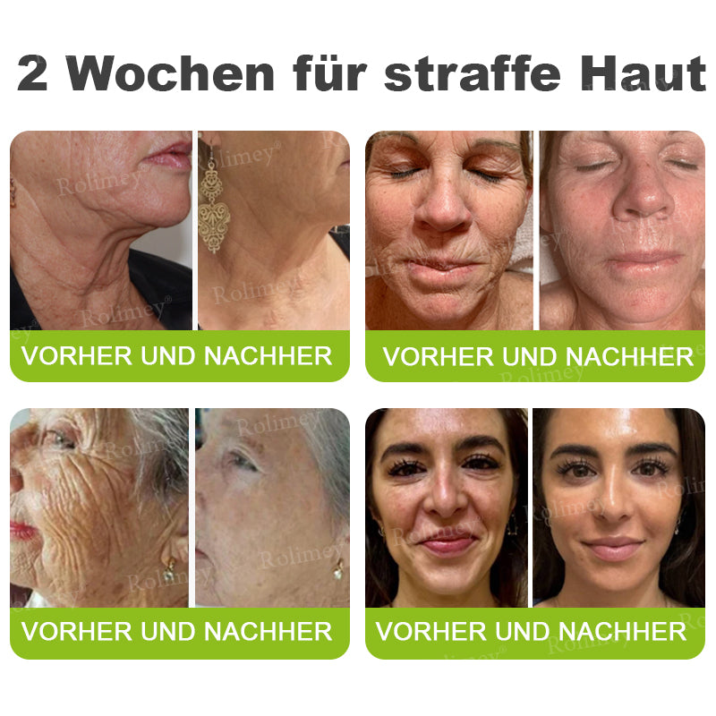 🛡️Jetzt jugendliche Haut zurückgewinnen Rolimey® Botox & Vita-A Retinol Shot Falten-Lift Straffungscreme